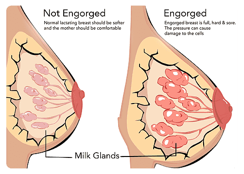 breast engorgement not breastfeeding