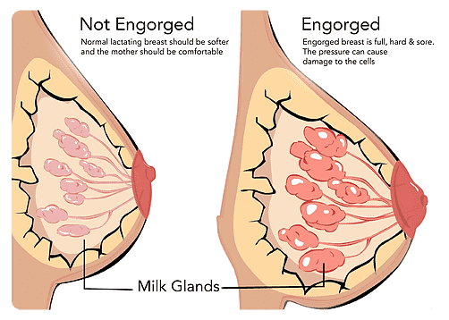 Breast Engorgement Relief — Rejoice Pregnancy
