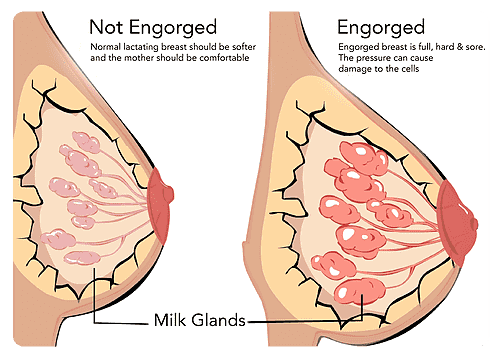 Breast Engorgement - Causes & Simple Tips for Relief