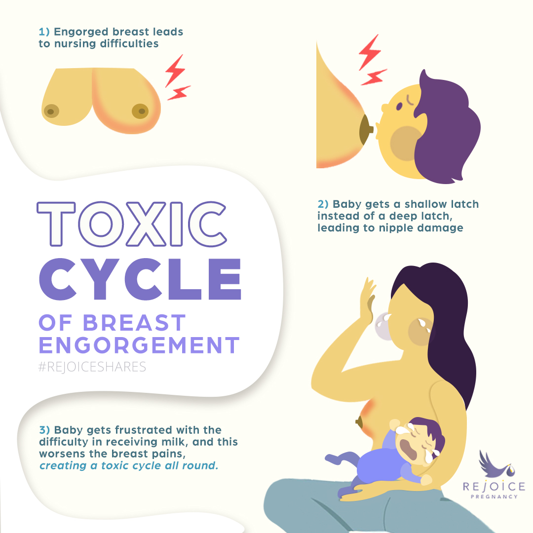 Breast Engorgement in Breastfeeding Mothers - Breastfeeding